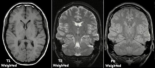 Examples of T1-weighted and T2-weighted brain MRI images