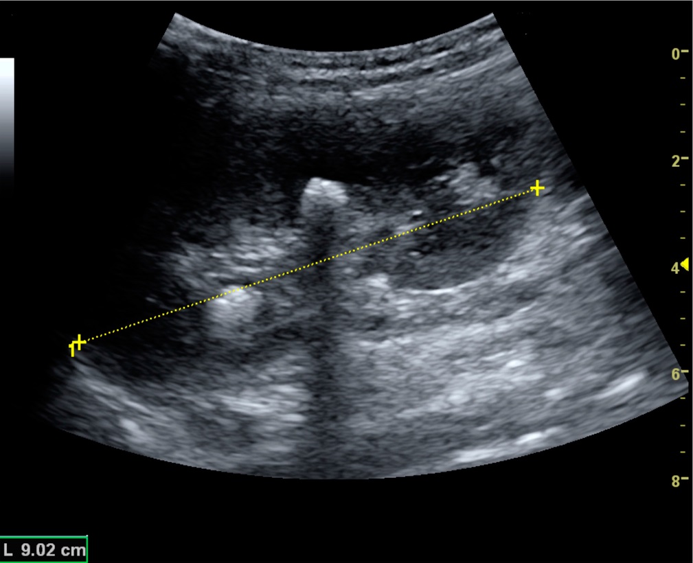 Ultrasound image showing a stone with posterior acoustic shadowing