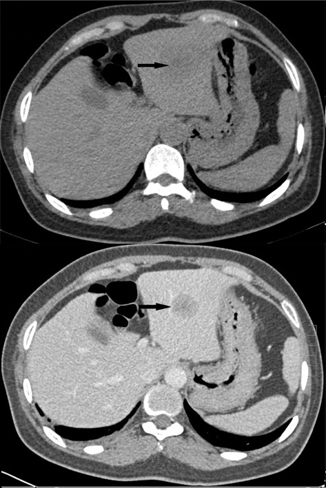 CT images without and with IV contrast