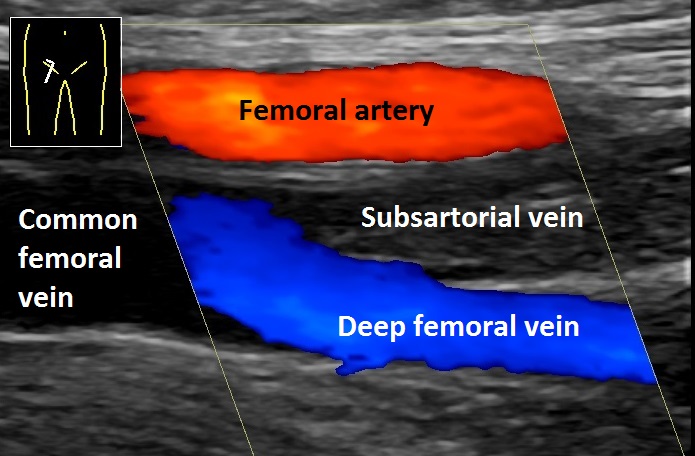 Ultrasound image showing deep vein thrombosis in the femoral vein