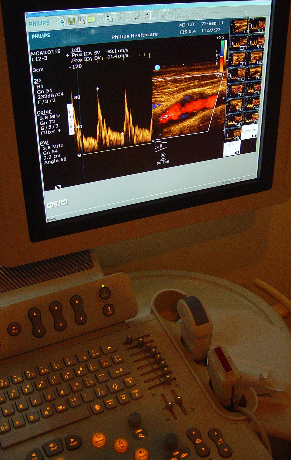 Color Doppler ultrasound examination of a carotid artery