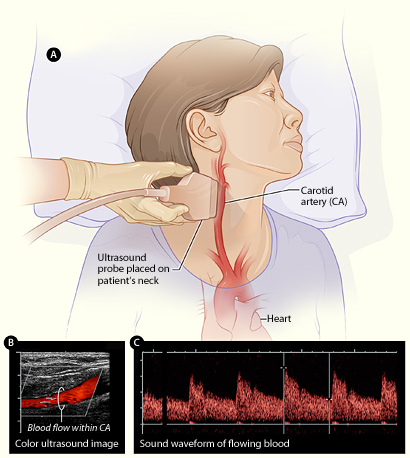 Duplex carotid ultrasound showing anatomy, color Doppler and waveform