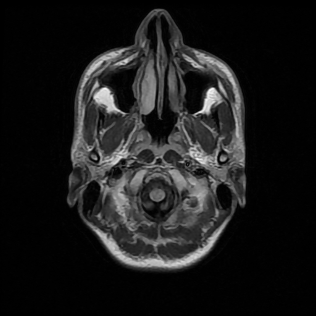 Axial FLAIR brain MRI