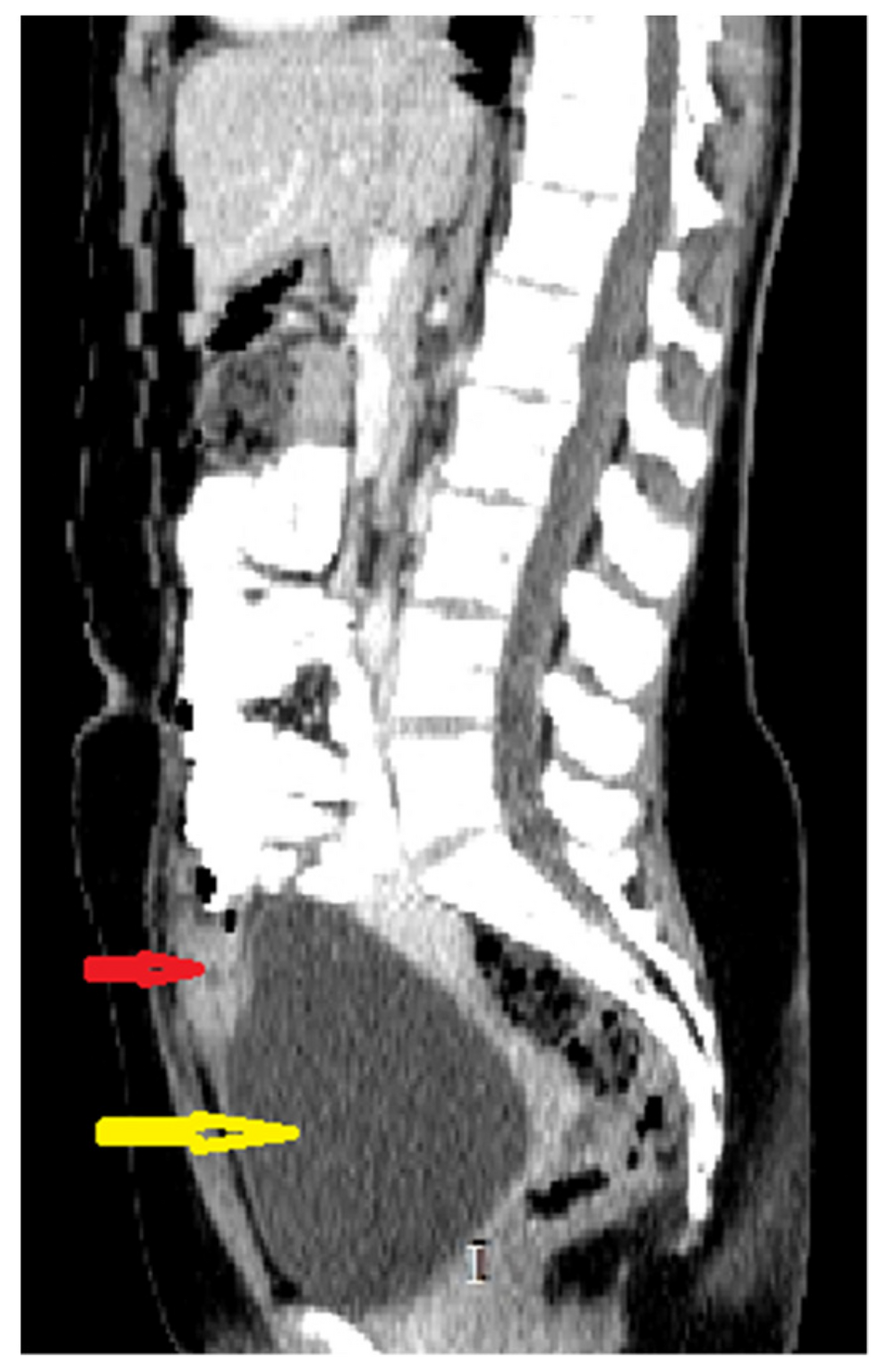 Abdominal and pelvic CT with intravenous and oral contrast