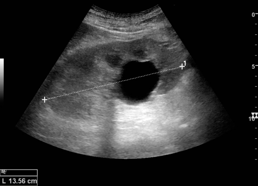 Ultrasound image of a simple cyst showing posterior acoustic enhancement