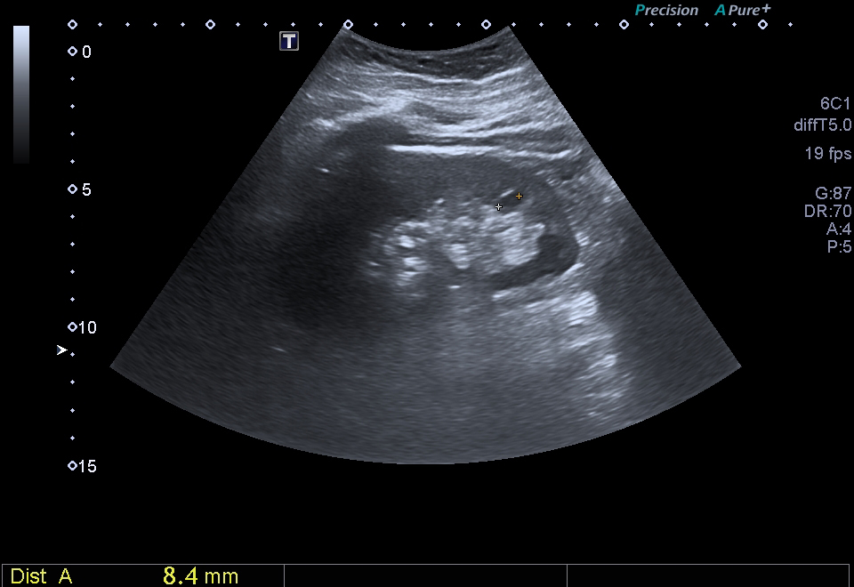 Small simple renal cyst seen on abdominal ultrasound
