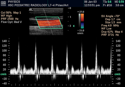 Spectral Doppler ultrasound waveform