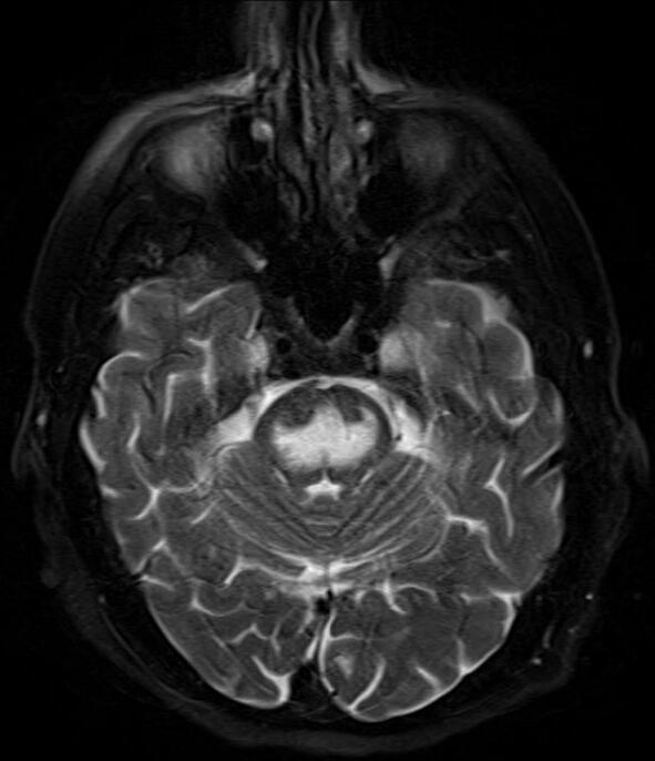 T2 fat-suppressed brain MRI